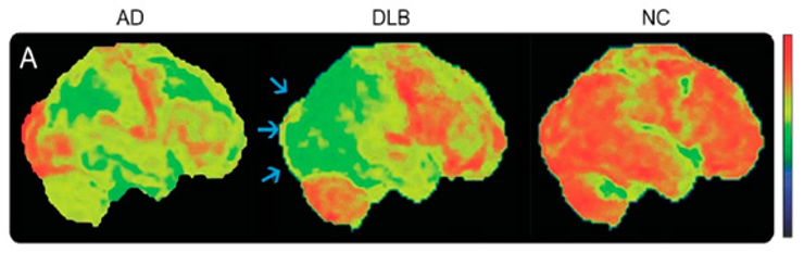 Acima, temos uma neuroimagem funcional demonstrando alteração no metabolismo colinérgico (áreas deficitárias em verde/ áreas funcionais em vermelho/laranja): Doença de Alzheimer (AD), Demência por corpúsculos de Lewy (DLB) e o cérebro normal (NC). Deve-se observar que a demonstração de comprometimento do córtex occipital evidenciado pelas setas na DLB, possivelmente se relaciona às alucinações visuais bem formadas.  