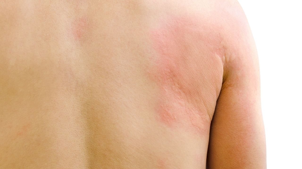 Urticária: faça o download do guia prático sobre a doença