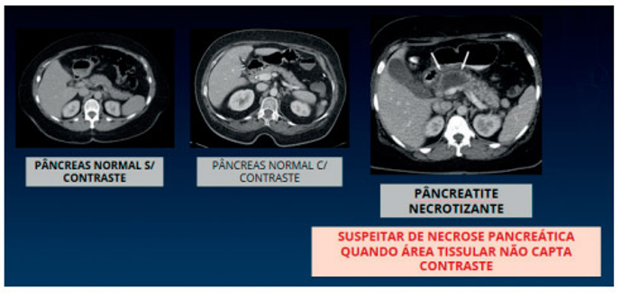 Necrose hepática