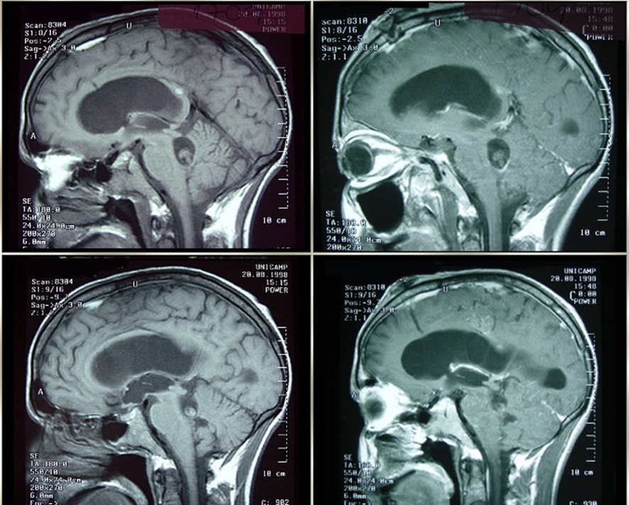 neurocisticercose:A neuroimagem é de grande valia, podendo demonstrar, transitoriamente, lesão cística/ racemosa, degeneração e calcificação