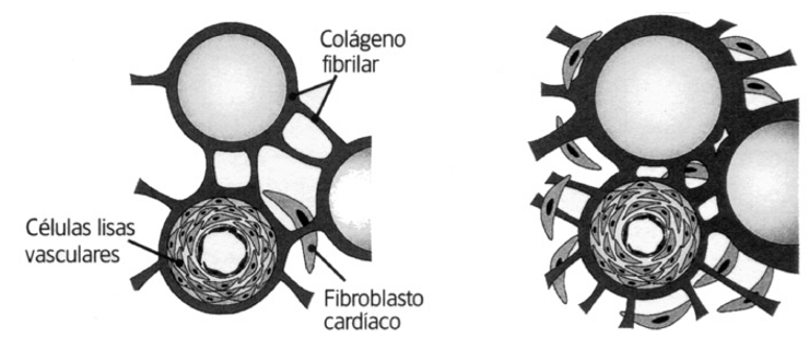 Hipertrofia ventricular 
