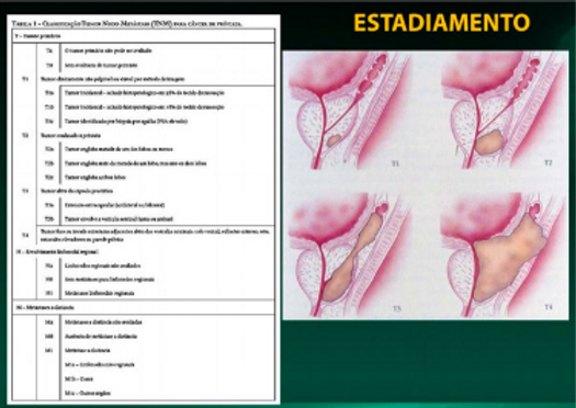 Estadiamento do câncer de próstata