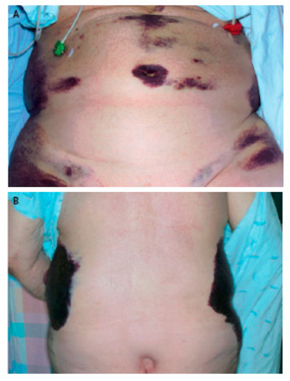 Paciente com pancreatite