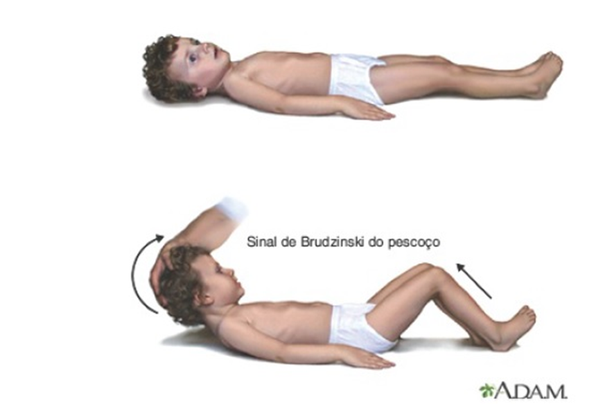  sinais de brudzinsky