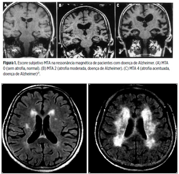 Imagem: Ressonâncias em T2/Flair mostrando em A, microangiopatia leve/moderada e, em B, moderada/severa,
identificada através de hipersinal periventricular, confluente. Observa-se, ainda, importante atrofia cortical difusa. 