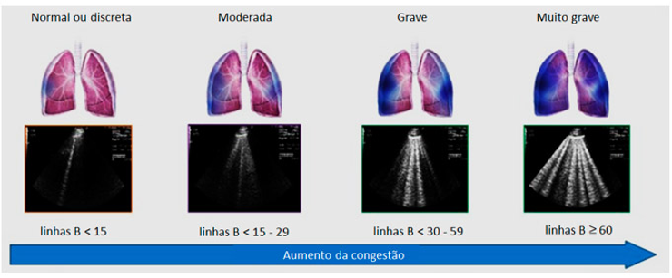 Ultrassonografia pulmonar