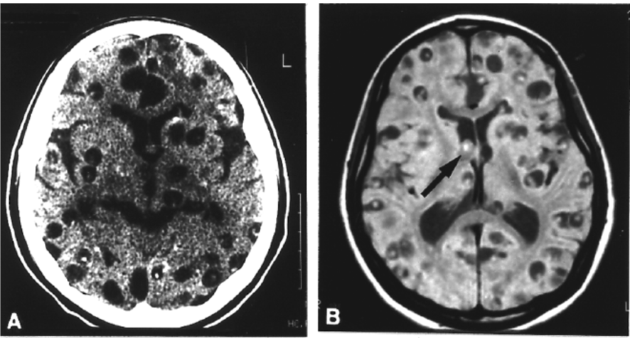  presença de cisto com escolex viável em neurocisticercose