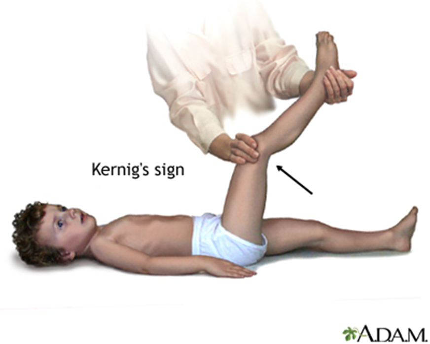  sinais de kernig