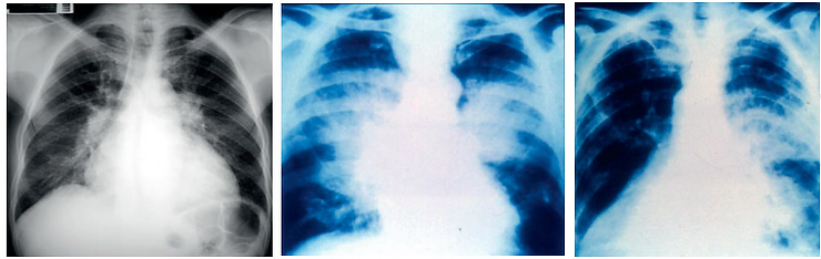 Radiografia de tórax