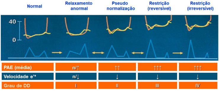 Avaliação da função diastólica  PAE = Pressão atrial esquerda; DD = disfunção diastólica
