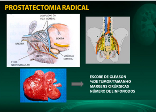 Prostatectomia radical 