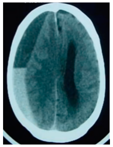 hematoma subdural: efeito decantação
