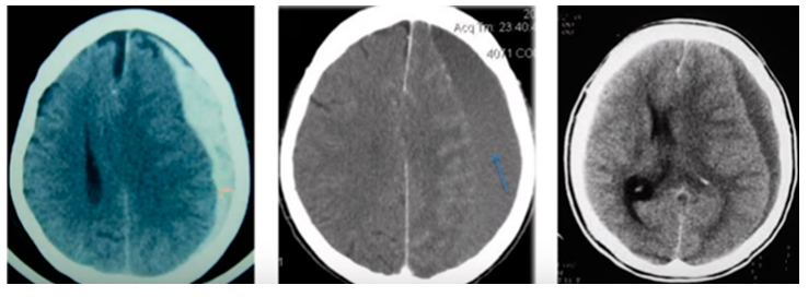 hematoma subdural