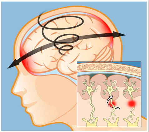 Lesão Axonal Difusa