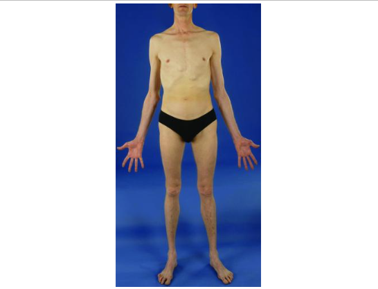Esse paciente com síndrome de Marfan é mais alto do que sua família e a envergadura do braço excede sua altura.