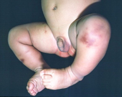 Mastocitose cutânea (Pernas): Essa imagem mostra a aparência de placas da mastocitose cutânea.