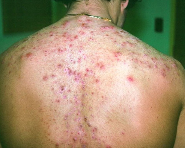 Acne cística:Essa imagem mostra nódulos supurativos consistentes com acne cística.