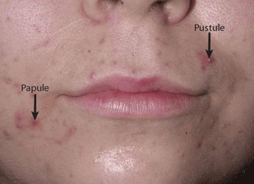 Acne (pápulas e pústulas): A acne mais comumente se manifesta como comedões (espinhas ou cravos) e também como pápulas (seta azul) e pústulas (seta preta).