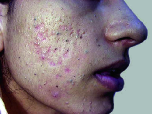 Acne com grandes comedões