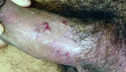 Papulose bowenoide Papulose bowenoide é às vezes considerada uma lesão pré-maligna. Ela pode se manifestar como pápulas marrom a vermelhas na genitália, nesse caso, na haste peniana.
