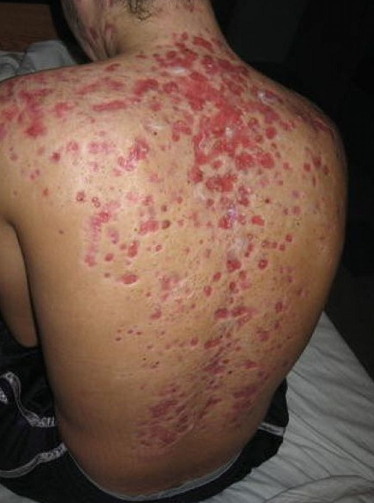 Acne fulminante: Esta foto mostra ulcerações confluentes e não confluentes resultantes de acne fulminante.