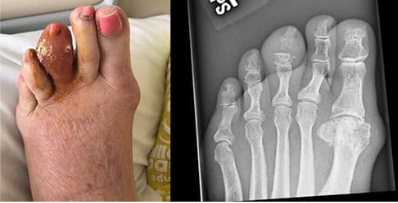 Gota do artelho médio: Essa foto mostra grandes tofos do terceiro artelho esquerdo, que se rompeu e liberou ácido úrico endurecido. A radiografia à direita mostra erosão da falange média e articulação interfalângica distal.