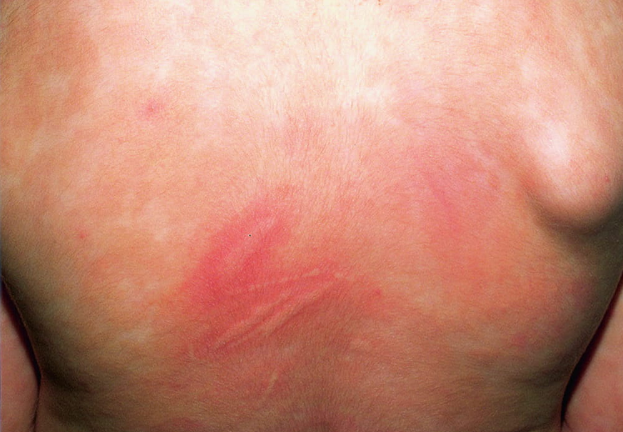 Sinal de Darier :Essa foto mostra o achado característico do edema transitório causado pela urticária ao redor do local da lesão, conhecido como sinal de Darier.