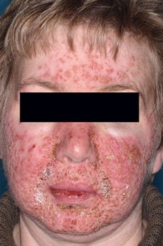 Pioderma facial (rosácea fulminante): Esta foto mostra piodermia facial com placas eritematosas, pápulas, pústulas e nódulos confluentes.