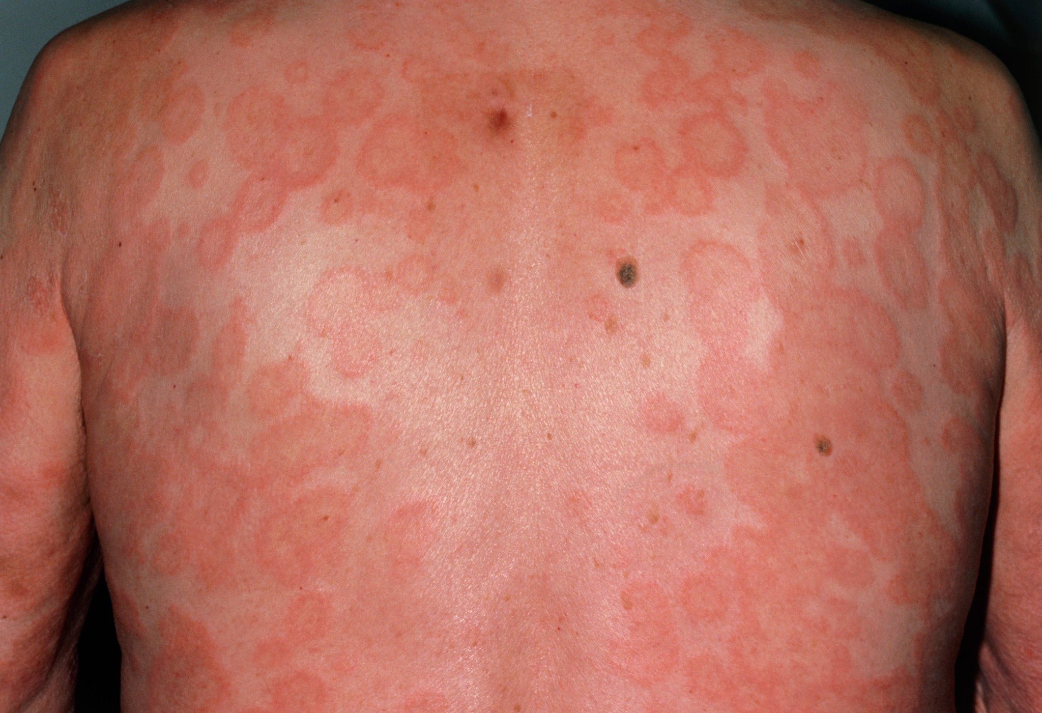 Eritema multiforme (costas)