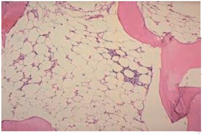 foto de exame de Medula hipocelular, com menos de 30% do espaço ocupado por células hematopoiéticas (substituídas por tecido adiposo), e células existentes de morfologia normal, com ausência de fibrose.
