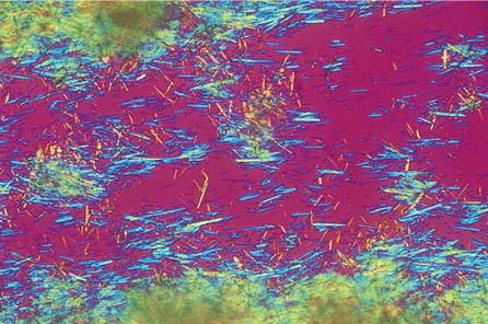 Cristais de gota Cristais de urato brilhantes e birrefringentes e em forma de agulha aspirados de um tofo gotoso podem ser vistos nessa imagem tirada com um microscópio de polarização e um filtro compensador vermelho. Os cristais negativamente birrefringentes aparecem amarelos quando estão paralelos ao eixo óptico do compensador e azuis quando perpendiculares.