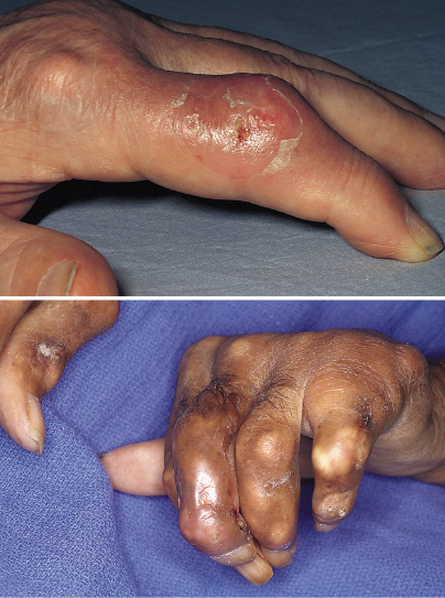A foto na parte superior mostra nódulos firmes, edema e drenagem serosa no dedo causados por gota tofácea. A foto na parte inferior mostra gota tofácea com deformidades na flexão nas mãos, que também podem estar acompanhadas por erosões destrutivas do osso e da cartilagem em múltiplas articulações.