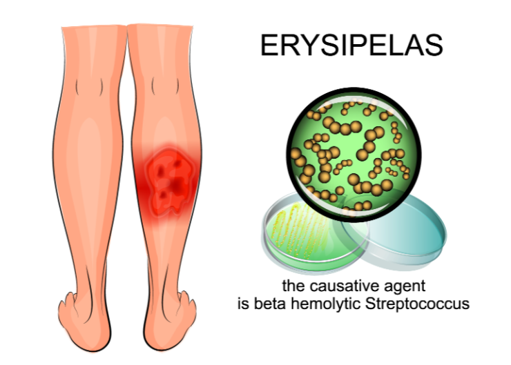 Doenças Dermatológicas Bacterianas Crônicas