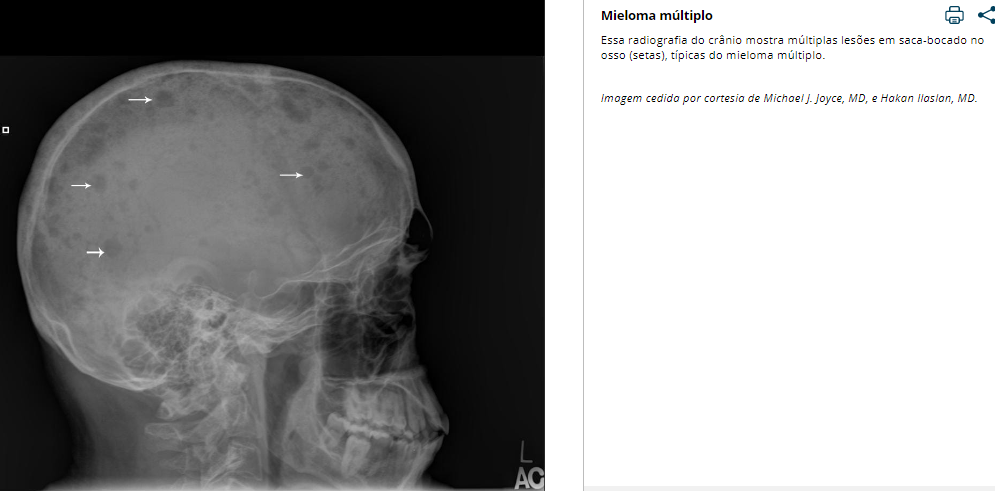 cranio humano com doença: mieloma multriplo