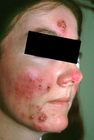 Pioderma facial (relacionado com a gestação): Essa imagem mostra pioderma facial com placas eritematosas, pápulas e pústulas que ocorreram durante a gestação.