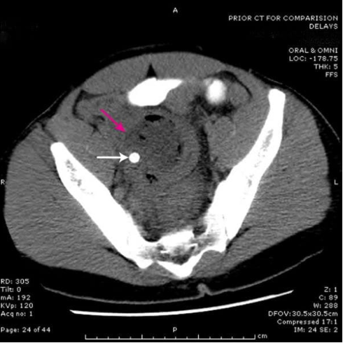 Abscessos pélvicos Um abcesso (seta vermelha) na pélve causado por apendicite é mostrado. Deve-se observar o fecalito radiopaco (seta branca).