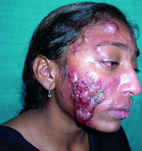 Acne conglobata na face