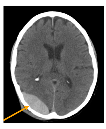 hematoma epidural