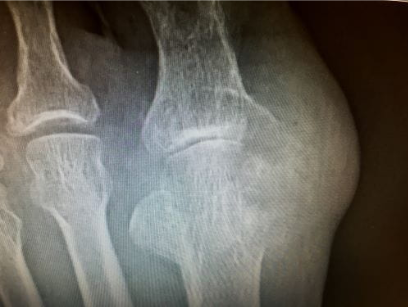 Foto mostra grandes erosões causadas pelos tofos envolvendo o osso metatarsal distal e na falange proximal do hálu