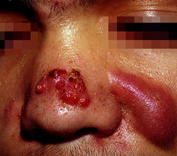 Acne com formação de abscessos