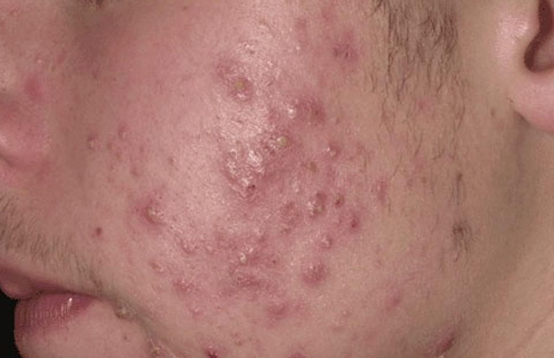 Pústulas são lesões elevadas, normalmente com pontas amarelas que contêm pus. Pústulas esparsas aparecem na face dessa pessoa com acne.