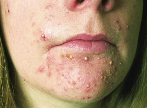 Acne com múltiplas pústulas