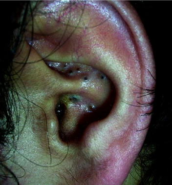 Acne com comedões auriculares