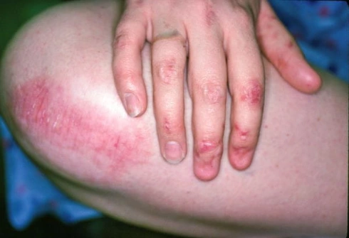 Epidermólise bolhosa (Mão e Joelho) Essa imagem mostra fragilidade epitelial das unhas e locais de alto atrito na mão e no joelho resultantes de epidermólise bolhosa.
