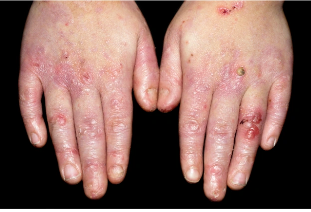 Epidermólise bolhosa (Mãos) Essa foto mostra as mãos de uma criança de 5 anos com cicatrizes, bolhas e perda das unhas da mão.
