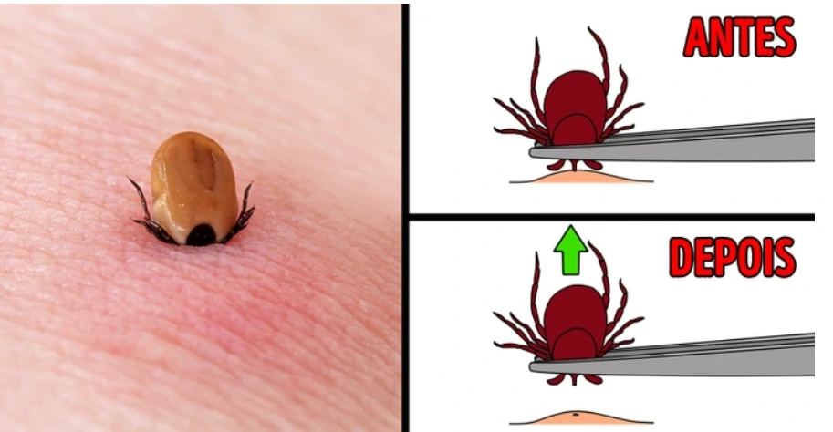 Posicione a pinça o mais próximo possível da pele, agarrando firmemente o corpo do carrapato, próximo à sua boca.