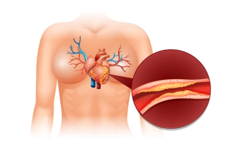 Doença arterial coronariana