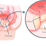 Câncer de Próstata é tema de artigo do Medicina Atual