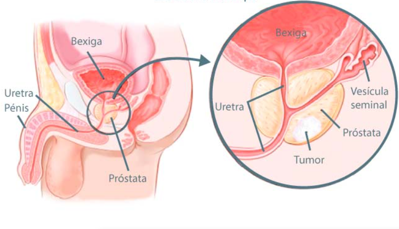 esquema sobre o câncer de próstata