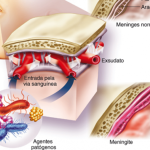 Doenças infecciosas e parasitárias: meningite virais e bacterianas